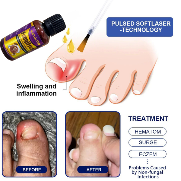 NAILGLOW Bee Venom Nail Serum (Buy 1 Get 1 FREE)