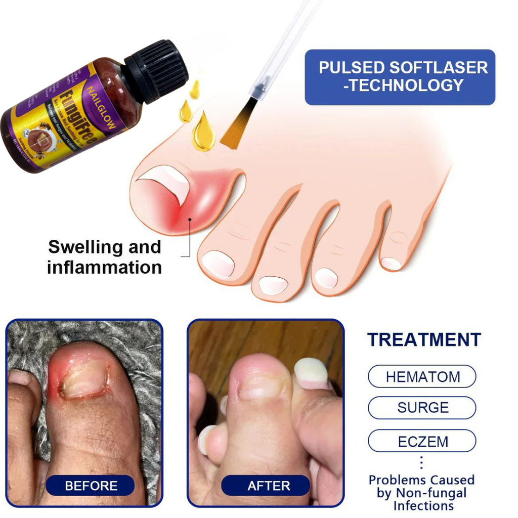 NAILGLOW Bee Venom Nail Serum (Buy 1 Get 1 FREE)