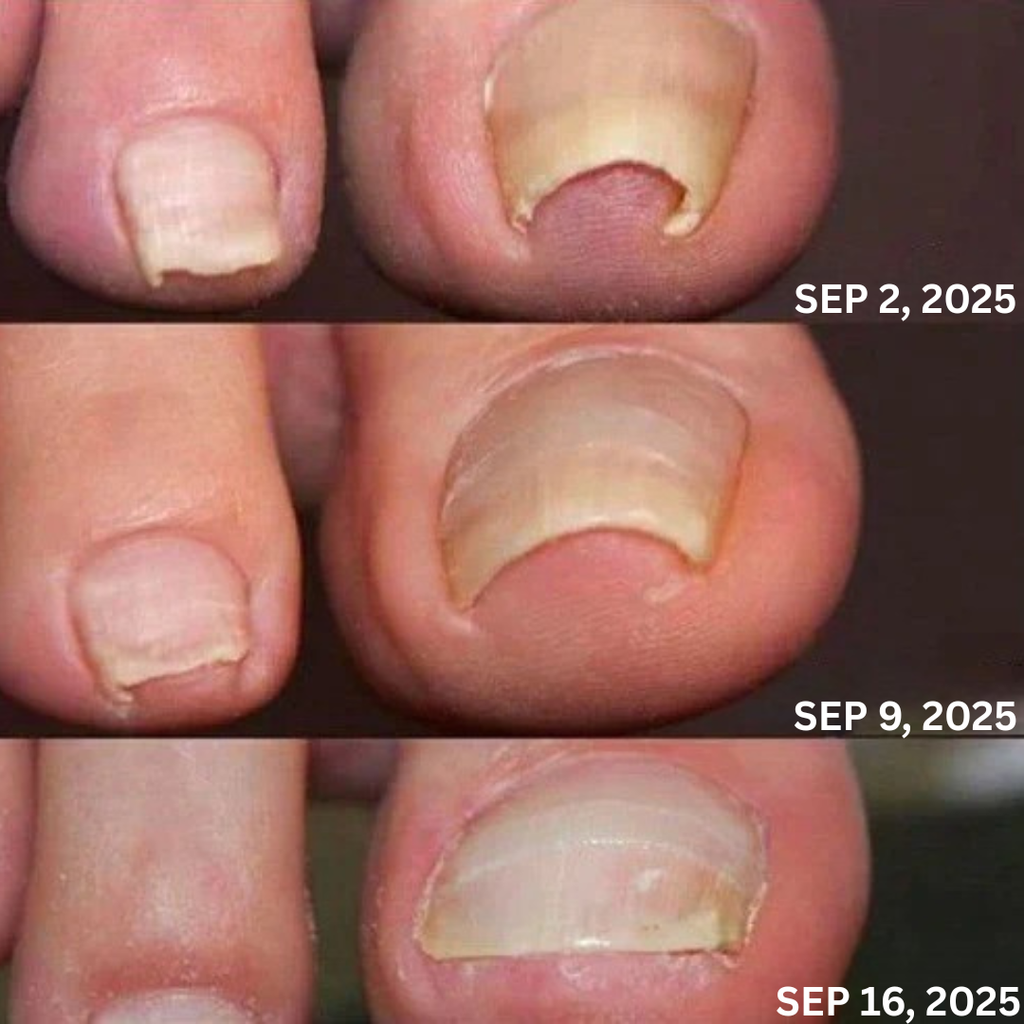 NAILGLOW Bee Venom Nail Serum (Buy 1 Get 1 FREE)