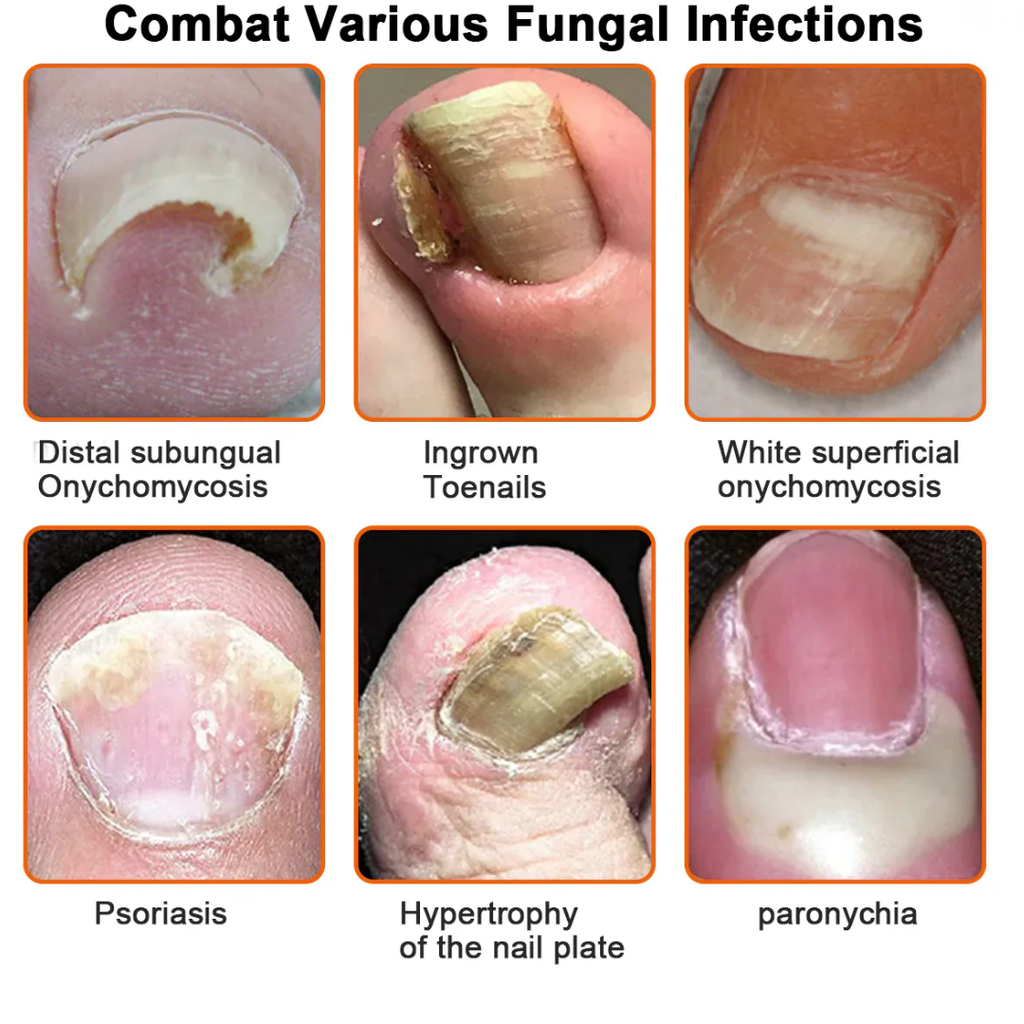 NAILGLOW Bee Venom Nail Serum (Buy 1 Get 1 FREE)